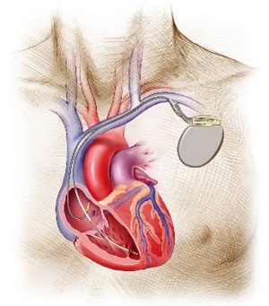 ペースメーカー植込みイメージ